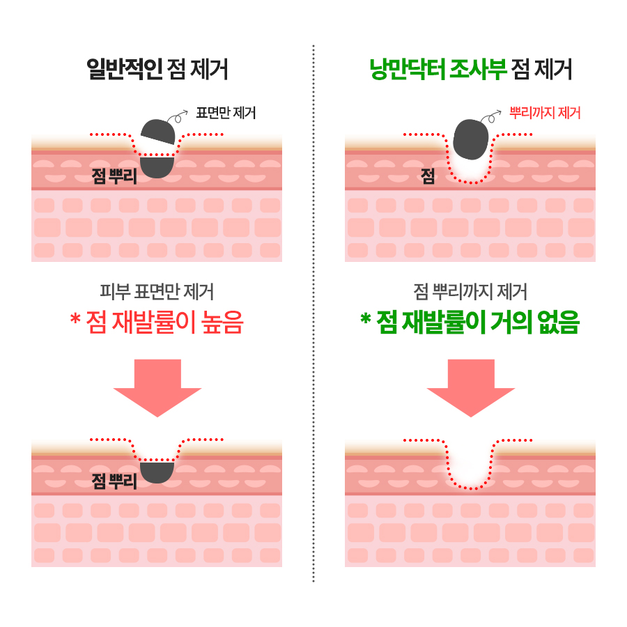 점이 다시 나는 이유? 점 재발 원인 및 재발점 제거 방법 - 장인닥터 조사부