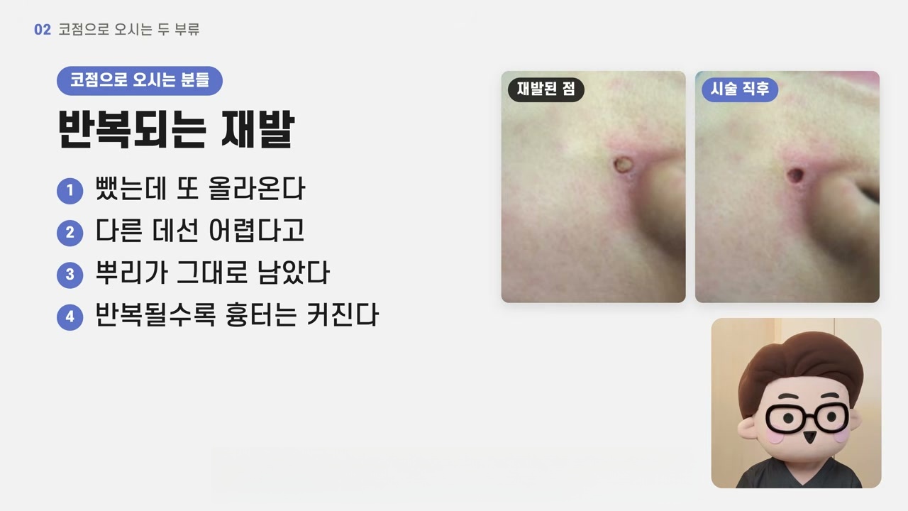 코점을 뺐는데 다시 올라오는 재발점, 시술 전과 시술 직후 모습을 정리한 영상 화면